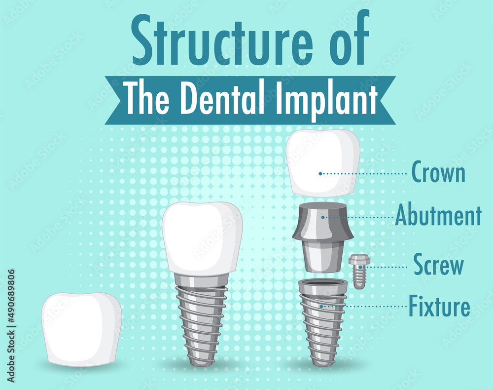 Infographic of human in structure of the dental implant Infographic of human in structure of the dental implant