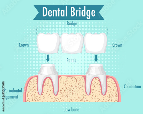 Infographic of human in dental bridge