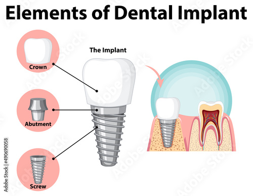 Infographic of human in structure of the dental implant