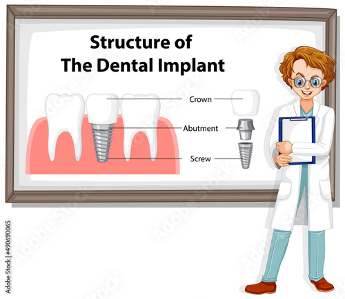 Infographic of human in structure of the dental implant