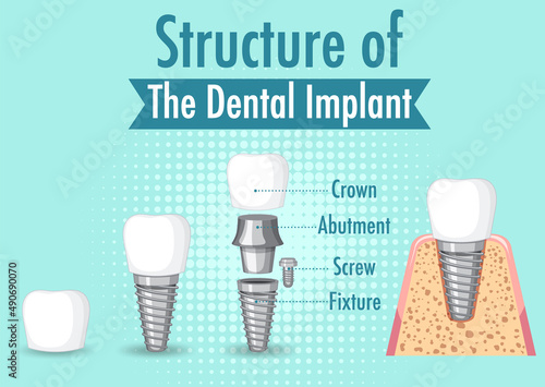 Infographic of human in structure of the dental implant