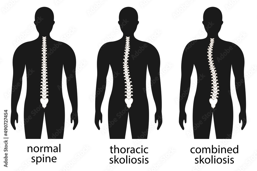 Vector illustration of spinal deformity. Kyphosis, lordosis, and ...