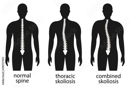 Vector illustration of spinal deformity. Kyphosis, lordosis, and scoliosis spine infographic. body posture defect. Medical, educational and scientific banners.