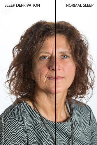 Фотография effects of sleep deprivation on a woman's face