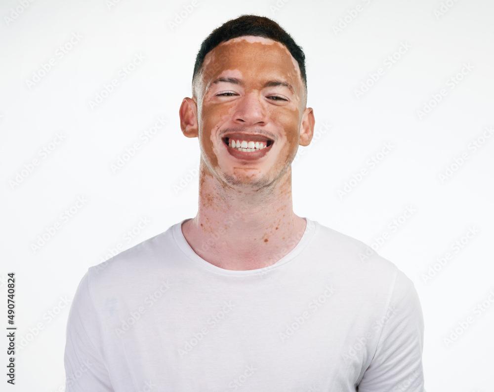 I have my flaws but I embrace them and love them because theyre mine. Portrait shot of a handsome young man with vitiligo posing on a white background. I have my flaws but I embrace them and love them because theyre mine. Portrait shot of a handsome young man with vitiligo posing on a white background.