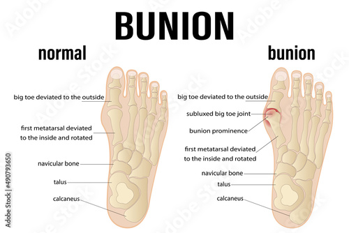 Hallux valgus medical infographic. Vector illustration