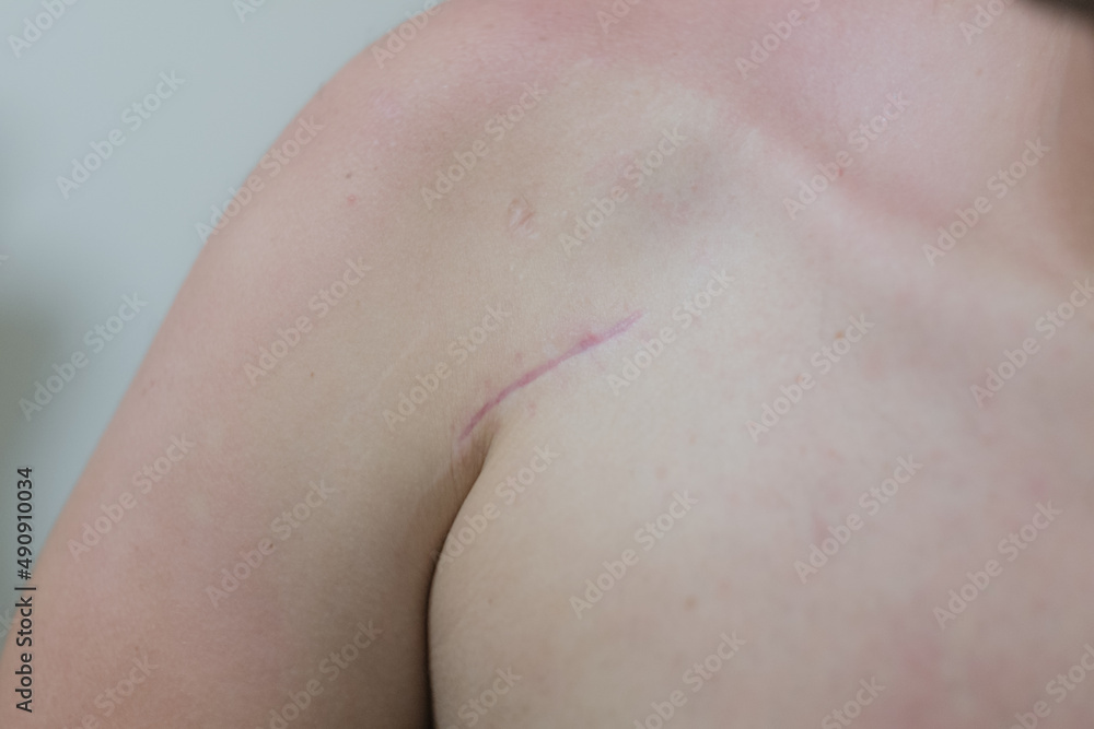 Fototapeta premium scar on a person's chest