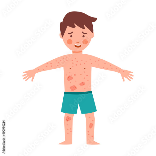 Boy Kids suffering from strong allergy skin itchy symptom in flat design. Red rash skin irritation.