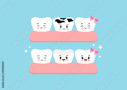 Cute teeth before and after multiple caries in gym dental characters. Tooth dentistry restoration with ceramic porcelain sealant in cavity treatment concept. Flat cartoon clip art vector illustration.