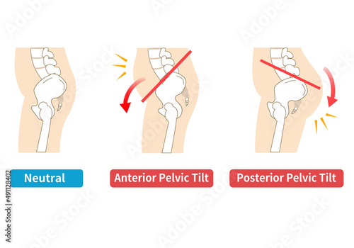 Relationship between pelvic tilt and posture.. photo