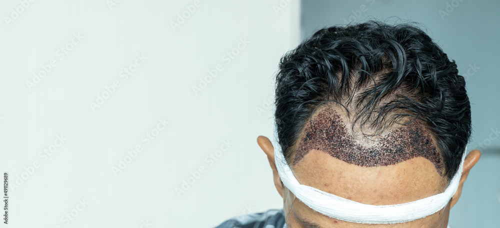 Man head with hair transplant surgery with receding hair line, FUE,  Follicular unit extraction, Types of hair transplant procedures and their  stages. Male alopecia treatment. Stock Photo | Adobe Stock