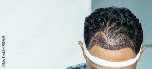 Man head with hair transplant surgery with receding hair line, FUE, Follicular unit extraction, Types of hair transplant procedures and their stages. Male alopecia treatment. photo