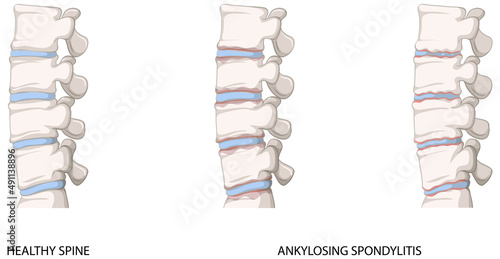 Infographic of healthy spine and ankylosing spondylitis photo