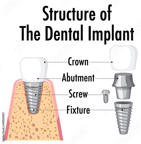 Infographic of human in structure of the dental implant