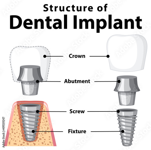 Infographic of human in structure of the dental implant