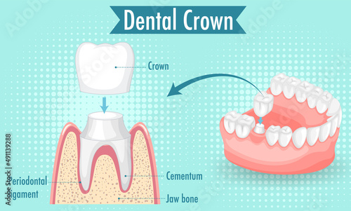 Infographic of human in dental crown