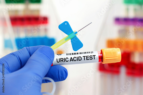 doctor with Blood tube and needle for Uric Acid test. Blood sample of patient for analysis of Uric Acid test in laboratory photo