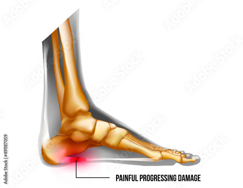 Foot pain, plantar fasciitis inflammation and ruptures strain realistic anatomy illustration