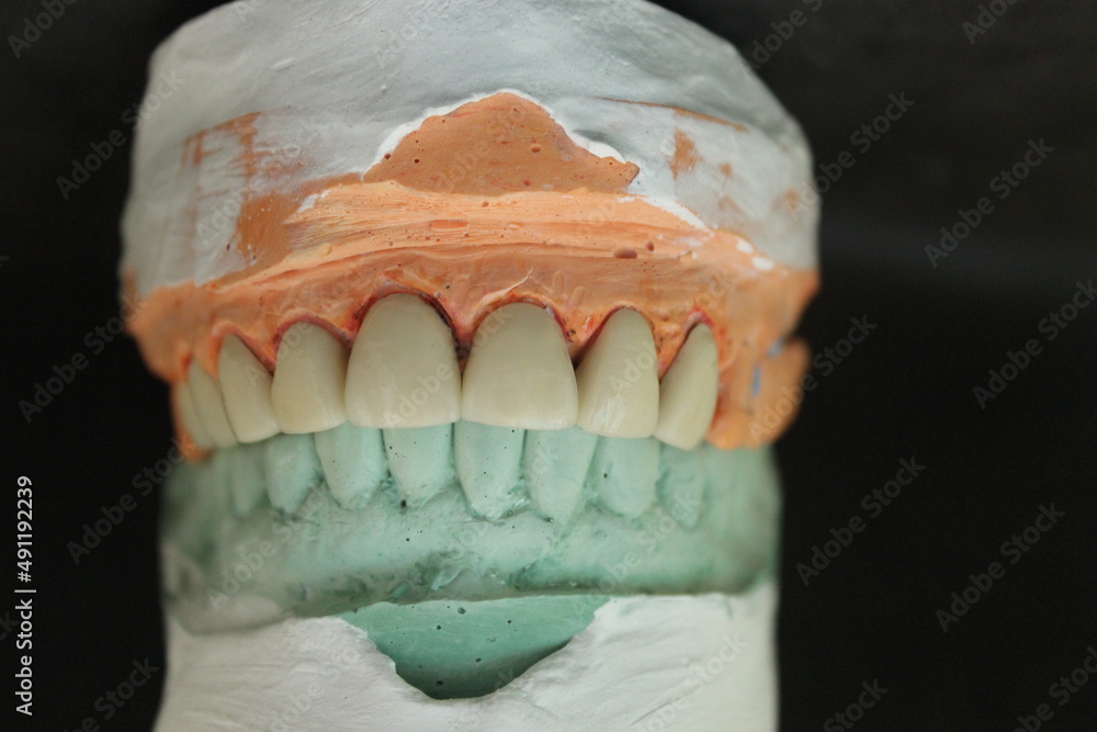 Obraz premium Dentures made of non-precious material and then baked with porcelain before the dentist puts them on the patient.
