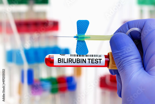 doctor with Blood tube and needle for Bilirubin test. Blood sample of patient for Bilirubin test in laboratory photo