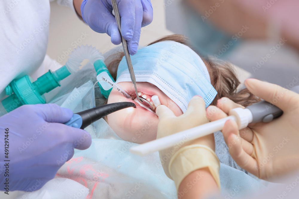 Treatment of caries of baby teeth under general anesthesia. Breathing tube.The doctor's hands are in protective gloves. Modern dentistry. Treatment of caries of baby teeth under general anesthesia. Breathing tube.The doctor's hands are in protective gloves. Modern dentistry.