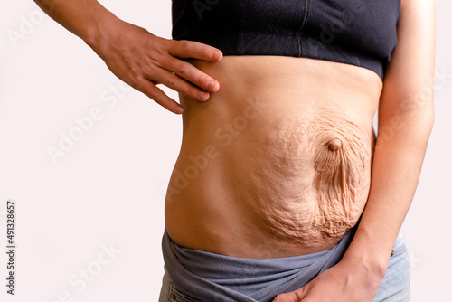 cropped woman dressed in black top and blue jeans. Diastasis and umbilical hernia after pregnancy