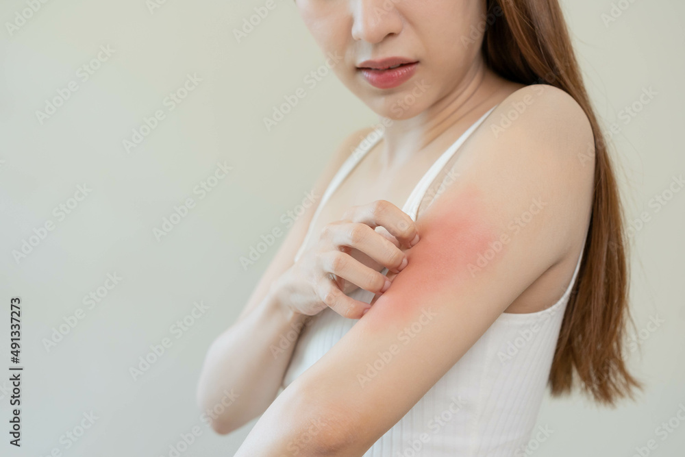 Dermatology, asian young woman, girl hand in her arm allergy, allergic reaction from atopic, insect bites, hand in scratching itchy, itch red spot or rash of skin. Beauty problem by medical treatment. Dermatology, asian young woman, girl hand in her arm allergy, allergic reaction from atopic, insect bites, hand in scratching itchy, itch red spot or rash of skin. Beauty problem by medical treatment.