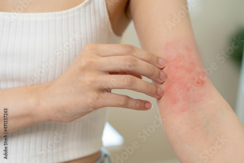 Dermatology, asian young woman, girl hand in her arm allergy, allergic reaction from atopic, insect bites, hand in scratching itchy, itch red spot or rash of skin. Beauty problem by medical treatment. © KMPZZZ