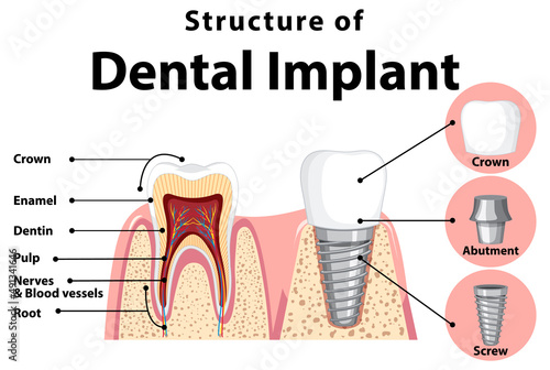 Infographic of human in structure of the dental implant