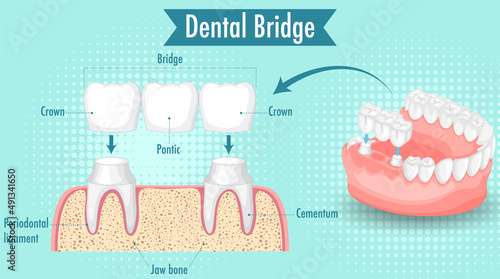 Infographic of human in dental bridge