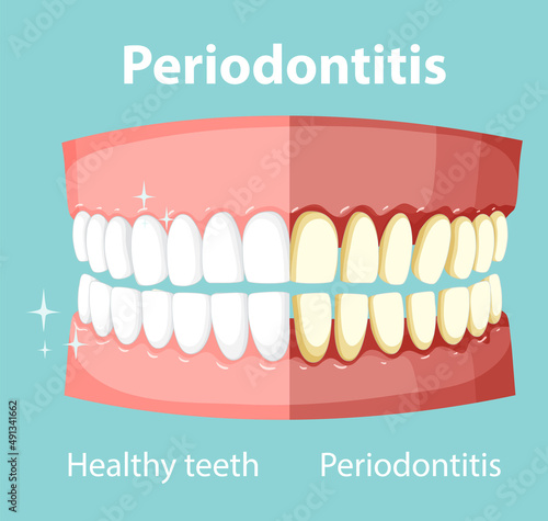 Infographic of human in periodontitis