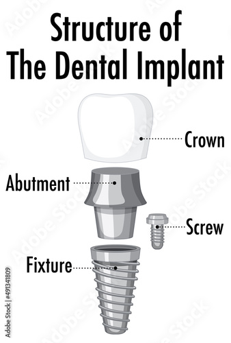 Structure of the dental implant on white background