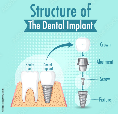 Infographic of human in structure of the dental implant