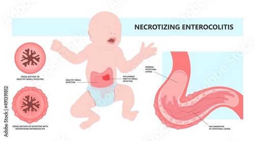 ileus bowel toxic small midgut cecal colon tract Hirschsprung's gastric Ladd band large hiatal hernia cancer tumor swollen crohn's x-ray meckel's twist blocked birth defect infant children pain short