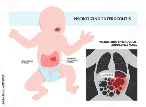 ileus bowel toxic small midgut cecal colon tract Hirschsprung's gastric Ladd band large hiatal hernia cancer tumor swollen crohn's x-ray meckel's twist blocked birth defect infant children pain short