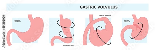 ileus bowel toxic small midgut cecal colon tract Hirschsprung's gastric Ladd band large hiatal hernia cancer tumor swollen crohn's x-ray meckel's twist blocked birth defect infant children pain short