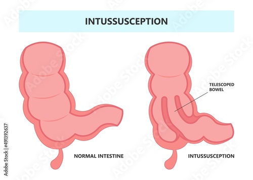 ileus bowel toxic small midgut cecal colon tract Hirschsprung's gastric Ladd band large hiatal hernia cancer tumor swollen crohn's x-ray meckel's twist blocked birth defect infant children pain short