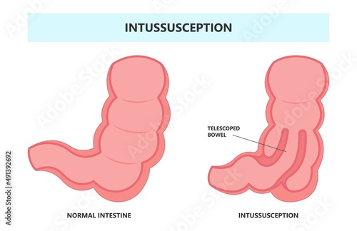 ileus bowel toxic small midgut cecal colon tract Hirschsprung's gastric Ladd band large hiatal hernia cancer tumor swollen crohn's x-ray meckel's twist blocked birth defect infant children pain short
