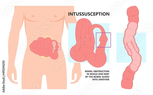 ileus bowel toxic small midgut cecal colon tract Hirschsprung's gastric Ladd band large hiatal hernia cancer tumor swollen crohn's x-ray meckel's twist blocked birth defect infant children pain short