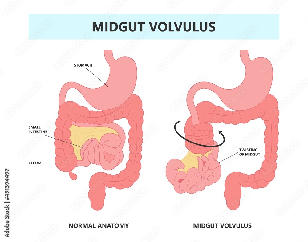ileus bowel toxic small midgut cecal colon tract Hirschsprung's gastric Ladd band large hiatal hernia cancer tumor swollen crohn's x-ray meckel's twist blocked birth defect infant children pain short ileus bowel toxic small midgut cecal colon tract Hirschsprung's gastric Ladd band large hiatal hernia cancer tumor swollen crohn's x-ray meckel's twist blocked birth defect infant children pain short