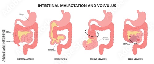 ileus bowel toxic small midgut cecal colon tract Hirschsprung's gastric Ladd band large hiatal hernia cancer tumor swollen crohn's x-ray meckel's twist blocked birth defect infant children pain short