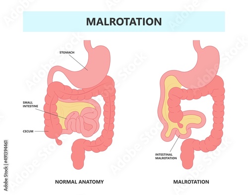 ileus bowel toxic small midgut cecal colon tract Hirschsprung's gastric Ladd band large hiatal hernia cancer tumor swollen crohn's x-ray meckel's twist blocked birth defect infant children pain short