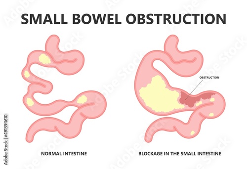 ileus bowel toxic small midgut cecal colon tract Hirschsprung's gastric Ladd band large hiatal hernia cancer tumor swollen crohn's x-ray meckel's twist blocked birth defect infant children pain short