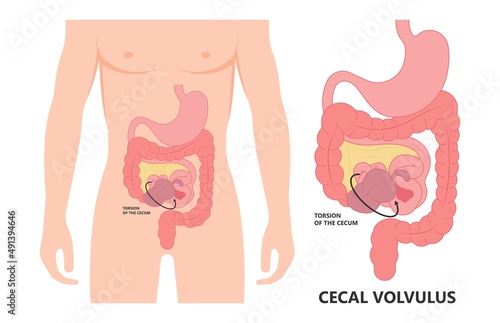 ileus bowel toxic small midgut cecal colon tract Hirschsprung's gastric Ladd band large hiatal hernia cancer tumor swollen crohn's x-ray meckel's twist blocked birth defect infant children pain short
