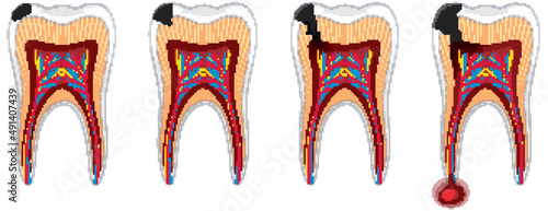 Human in the stages of tooth decay