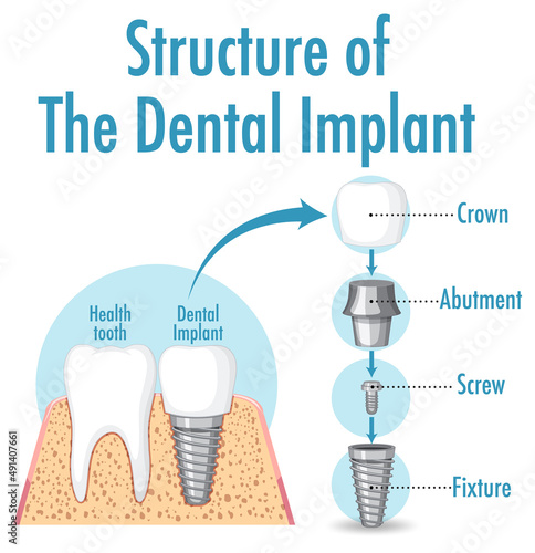 Infographic of human in structure of the dental implant