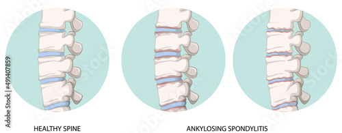 Infographic of healthy spine and ankylosing spondylitis photo