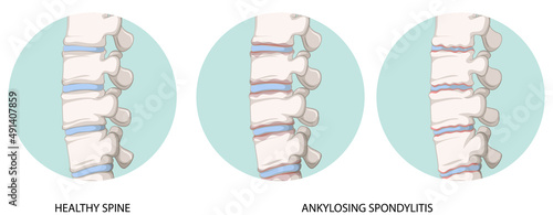 Infographic of healthy spine and ankylosing spondylitis