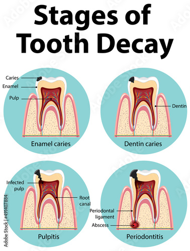 Infographic of human in the stages of tooth decay