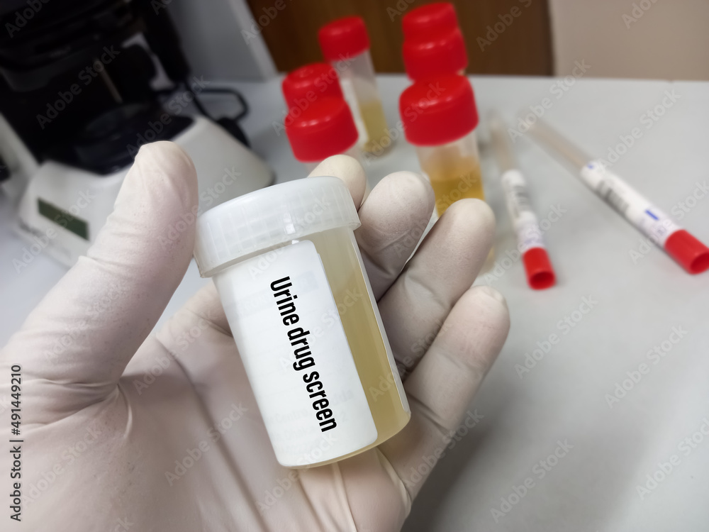 Tab technician holds Urine drug screen test sample, also known as a
